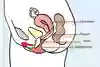 Underlivet i genomskärning, där ett vaginalpessar sitter i slidan, en bit upp och för livmodertappen. Illustration.