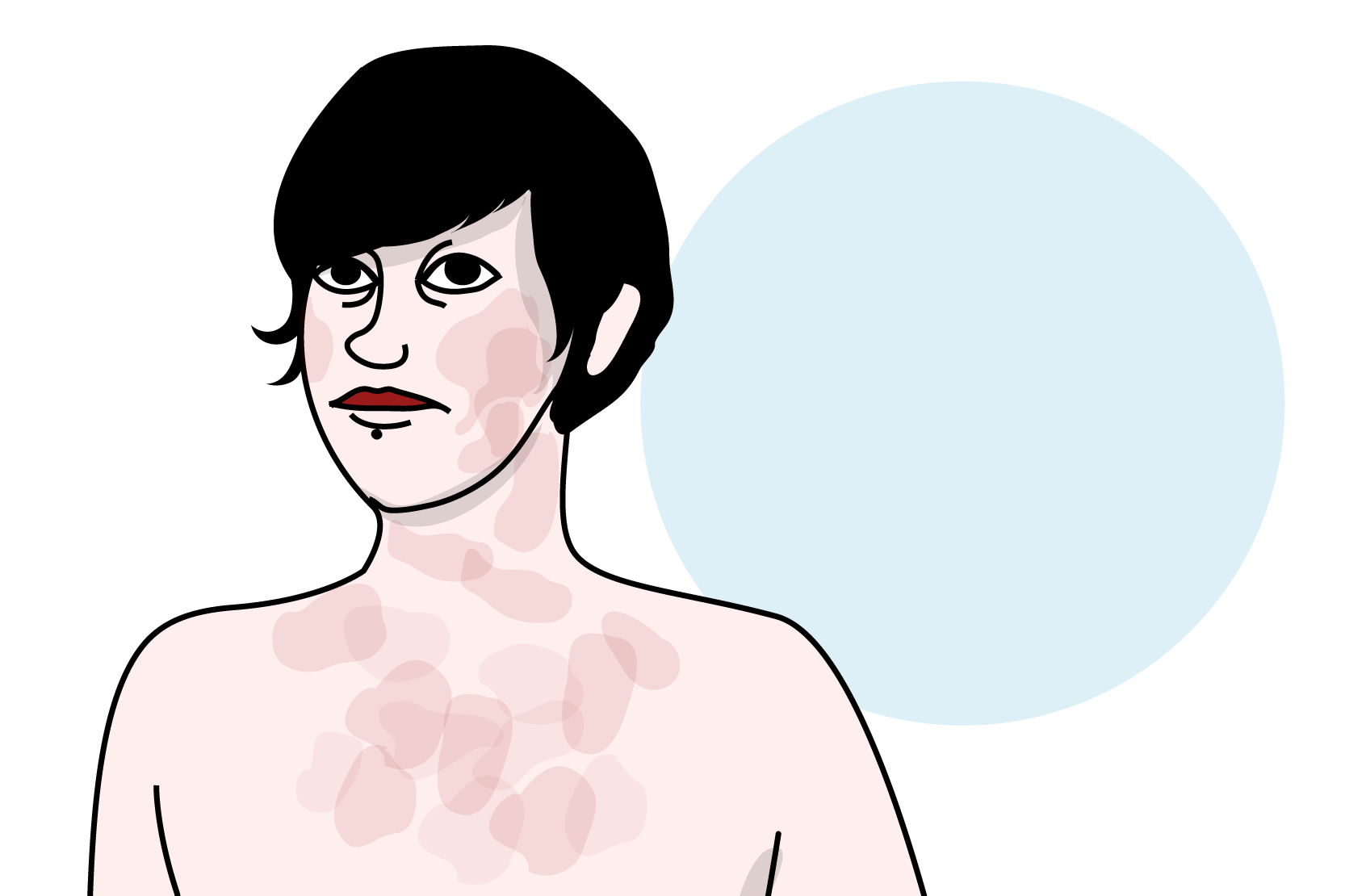 En person med flammigt och fläckigt bröst, illustration. 