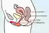Underlivet i genomskärning, där ett cervixpessar sitter längst upp i slidan, för livmodertappen. Illustration.