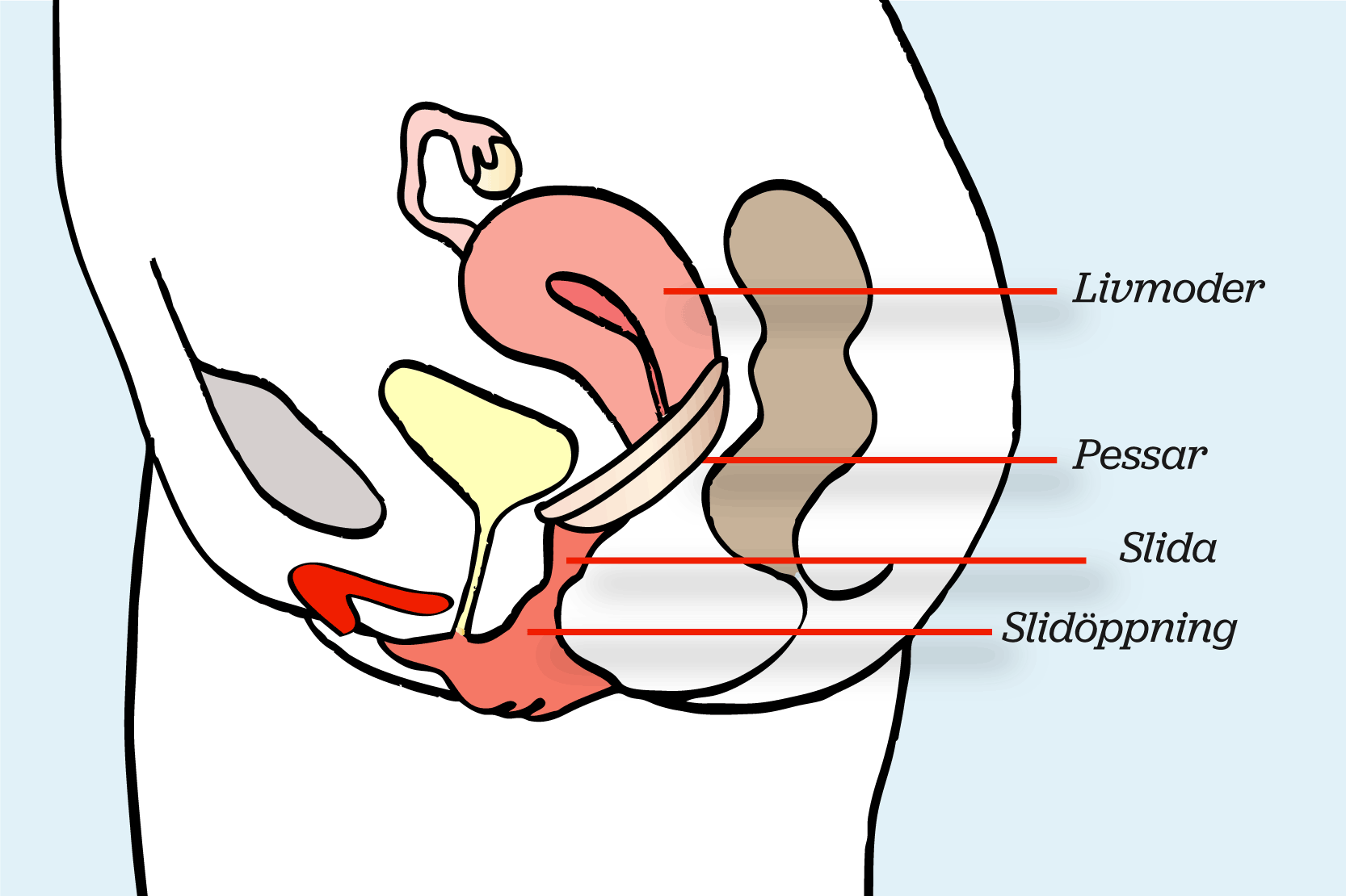 Underlivet i genomskärning, där ett vaginalpessar sitter i slidan, en bit upp och för livmodertappen. Illustration.