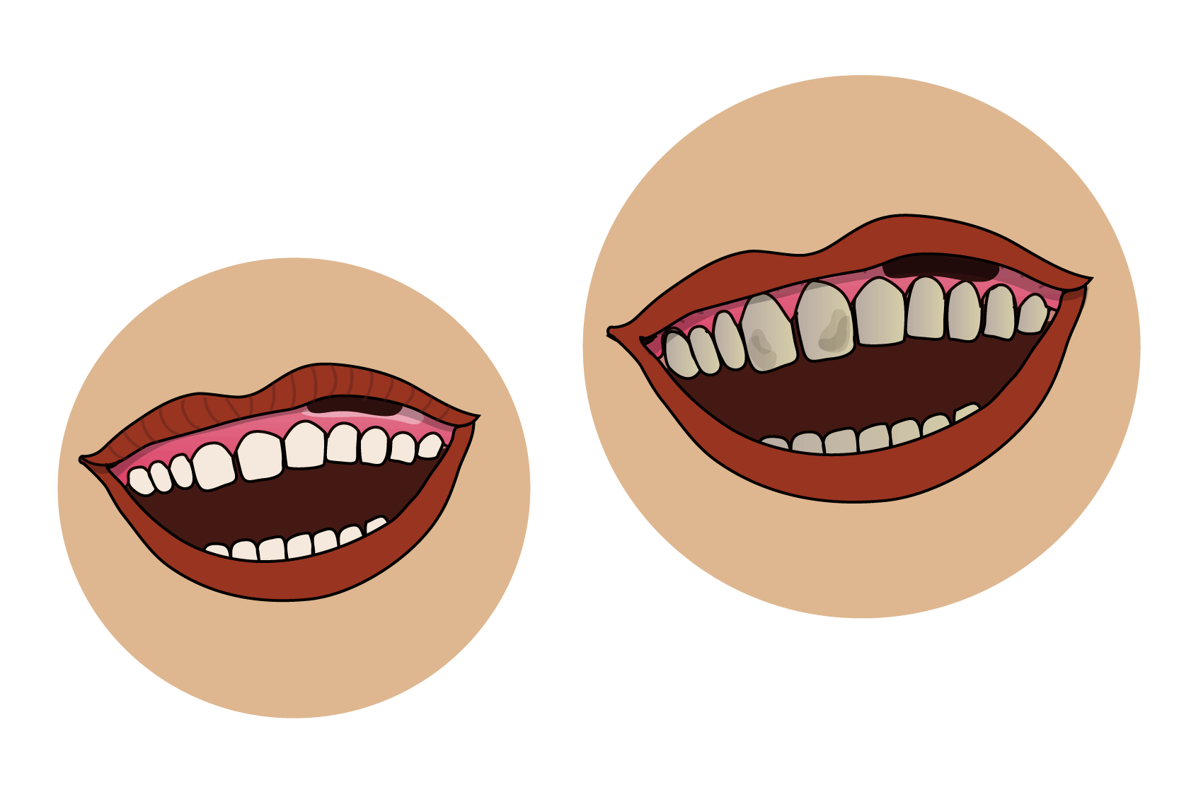 En bild av en öppen mun med vita tänder och en prilla under läppen. En bild av en mun med fläckiga, gråbruna tänder där tänderna täcks mindre av tandköttet och med en prilla under läppen. Illustrationer.