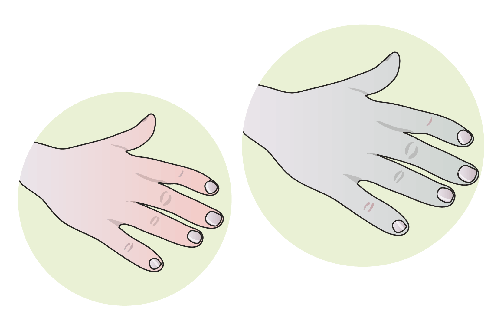 En bild av en beigefärgad hand och en bild av en likadan hand som är mer blåfärgad. Illustrationer.