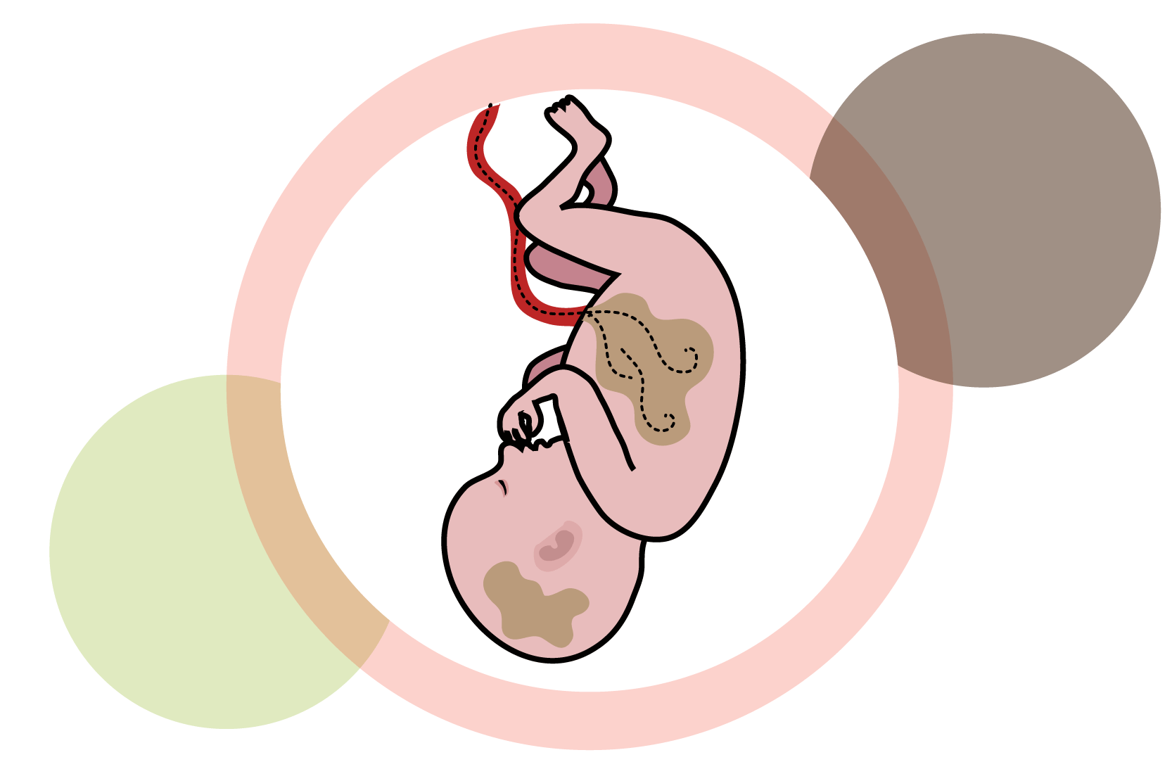 Ett foster med bruna fläckar i magen och huvudet som symboliserar giftiga ämnen. Illustration.