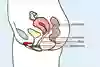 Underlivet i genomskärning, med en femidom i slidan, från slidöppningen upp till livmodern. Illustration. 