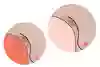 Två armhålor. I den ena armhålan syns hårväxt och i den andra hårväxt, svettdroppar och en symbol för att det luktar svett i form av vågor i luften. Illustration.